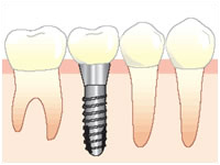 implant01