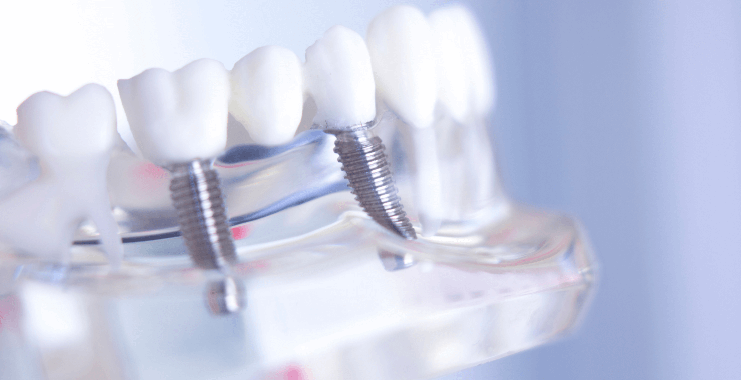 インプラント治療